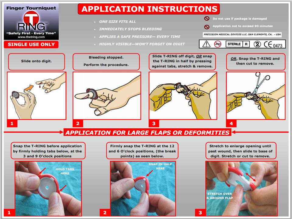 T-Ring instructions for use